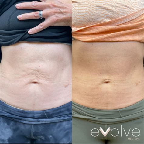 Tighten Skin of Abdomen . . Morpheus8 before and after stomach